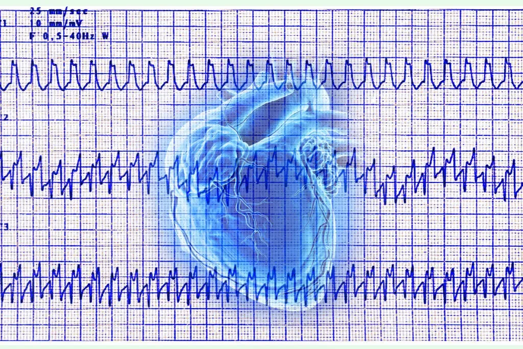 Atrial tachycardia electrocardiogram, heart rhythm disorder where the patient complains of rapid palpitation sensations.