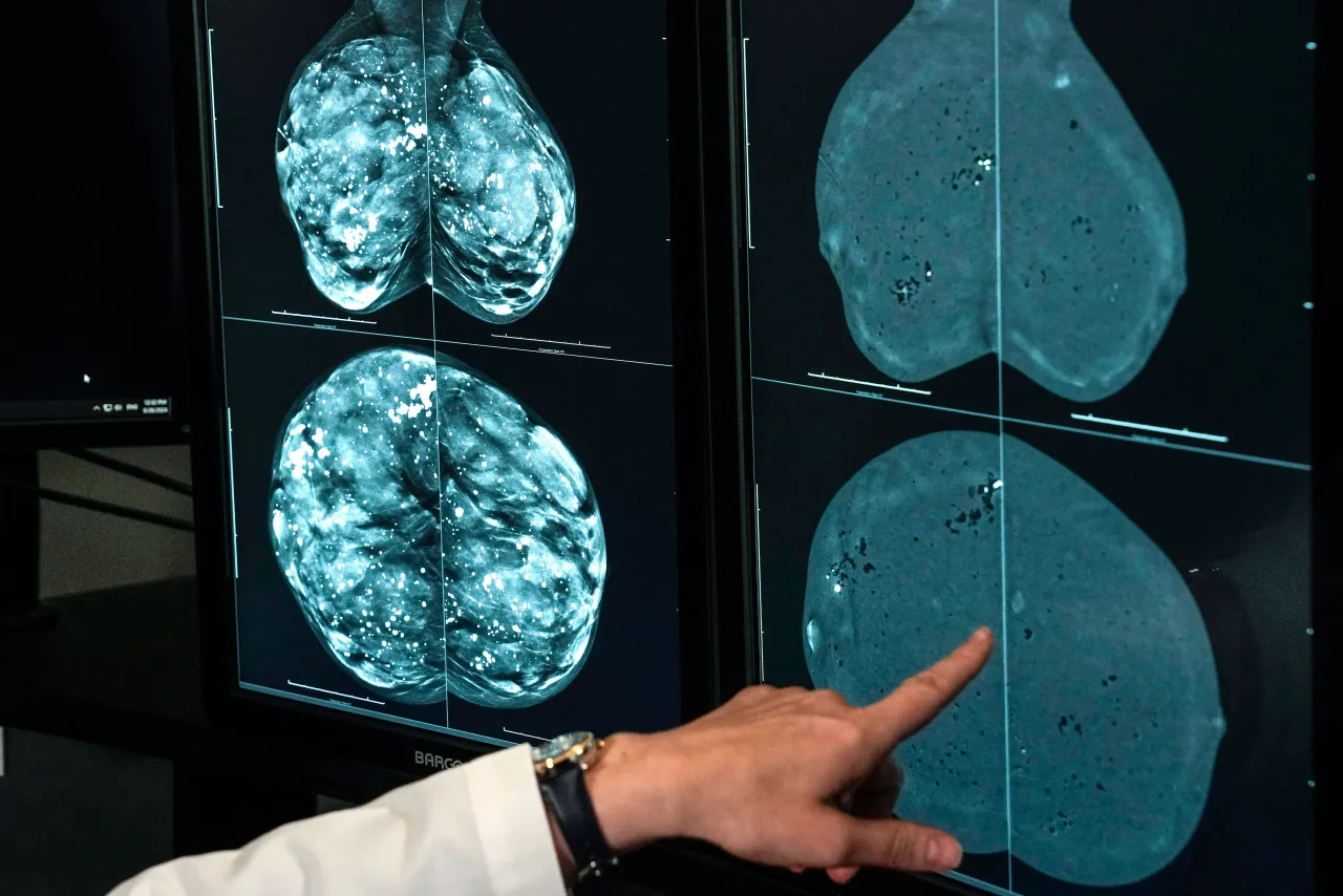 Mammogram imagery, regular mammogram on the left, and contrast enhanced mammogram on the right, on Thursday, Sept. 26, 2024 in Houston. (Brett Coomer/Houston Chronicle via Getty Images)