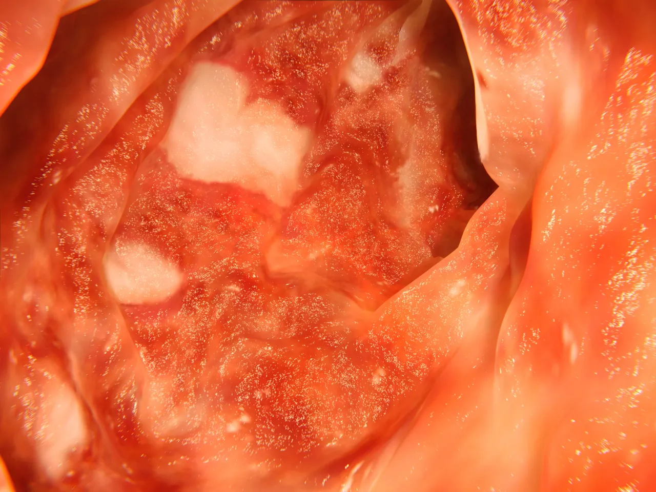 Artwork based on an endoscopic image of the colon affected by ulcerative colitis (Photo Courtesy of Juan Gartner via Getty Images)